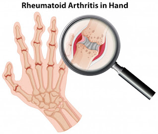 Various Methods to Manage Arthritis Pain Various Methods to Manage Arthritis Pain