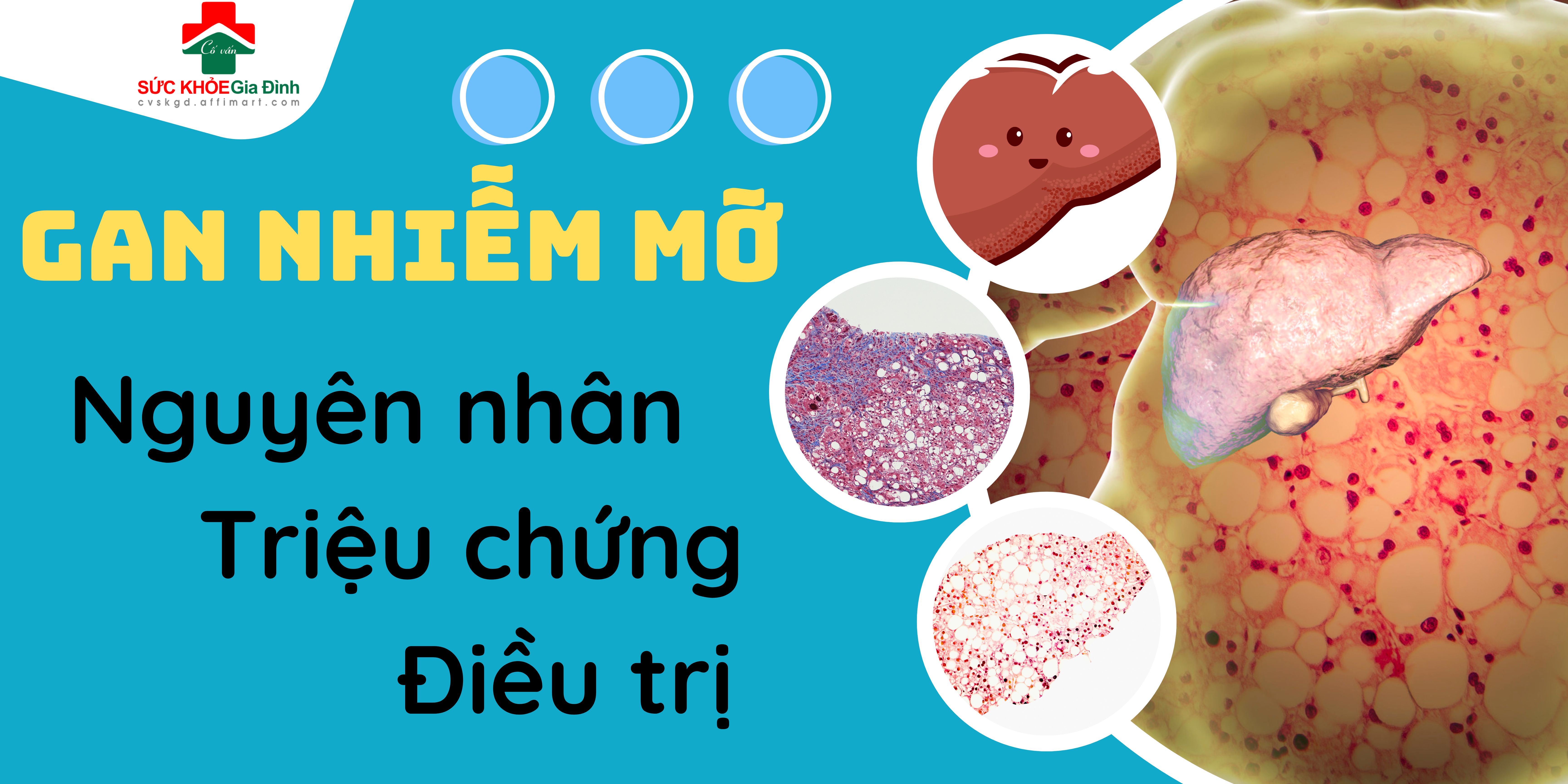 Gan nhiễm mỡ: Nguyên nhân, triệu chứng, phòng ngừa và cách điều trị