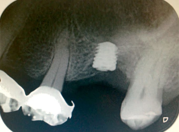 PDF: Implantes dentales cortos en la rehabilitación de los maxilares atróficos