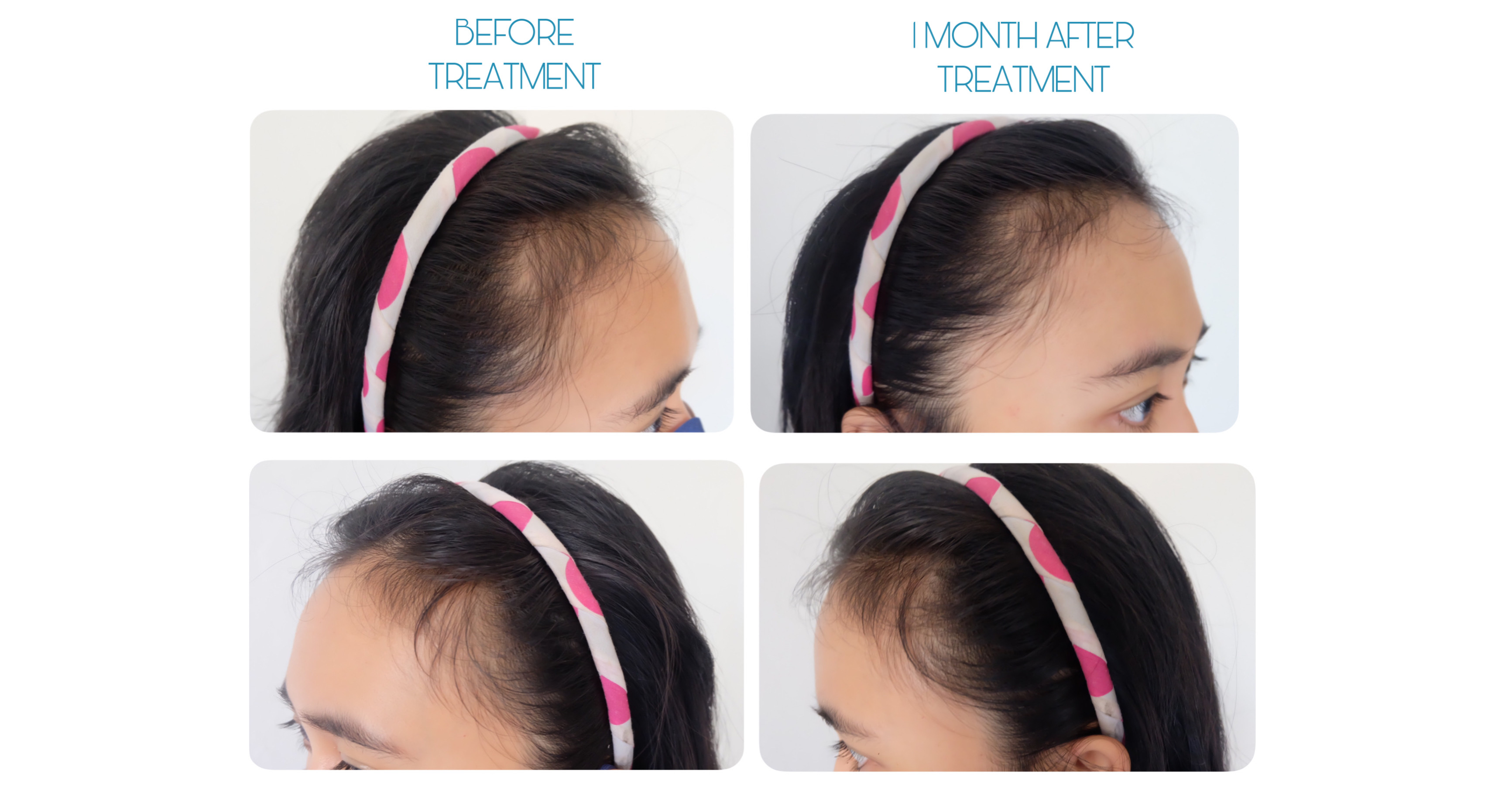 Atasi Rambut Rontok dan Kebotakan dengan Love is in The Hair Program by ERHA Ultimate Hair Care