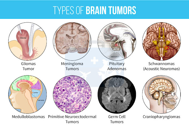Types of Brain Tumor