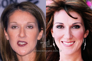 Celine Dion Teeth Before and After