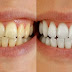 Tẩy sạch cao răng, giúp răng trắng và đều màu