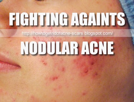 Get Rid Nodular Acne