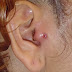 Infected Ear Piercig