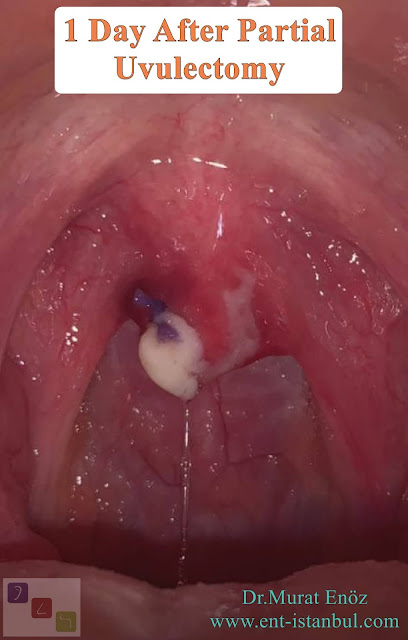 Oral Papillomas (Warts),uvulectomy,Papilloma of Uvula,oral HPV infection,Human Papillomavirus,Partial uvulectomy,