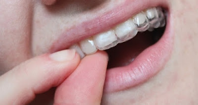 Invisalign Teen New York City