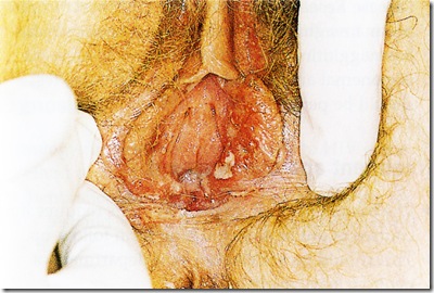 Herpes GEnitalis