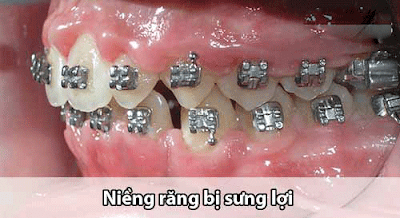  Lớn tuổi có niềng răng được không?