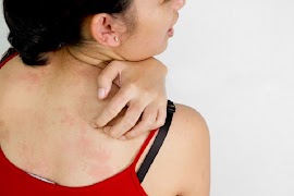 Natural Remedies For Itching