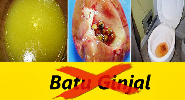 Obat Batu Ginjal Alami