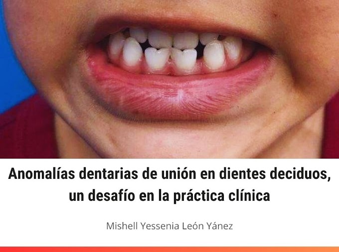 PDF: Anomalías dentarias de unión en dientes deciduos, un desafío en la práctica clínica