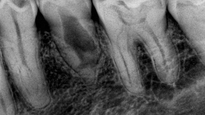 PDF: Reabsorción dentaria interna. Presentación de un caso