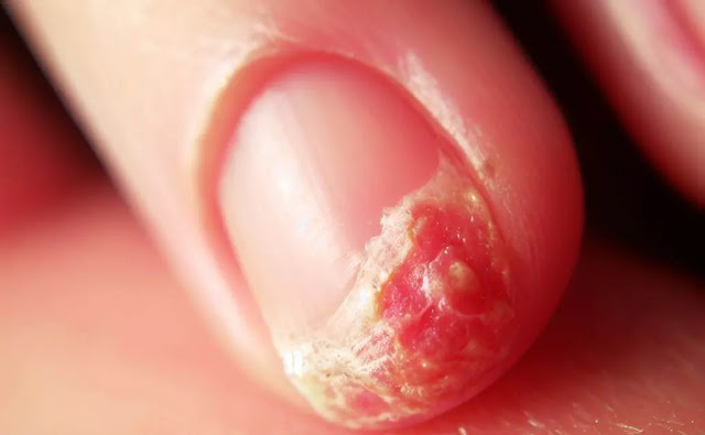 Signs of Skin Cancer Under Nail