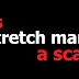 Is stretch mark a scar?