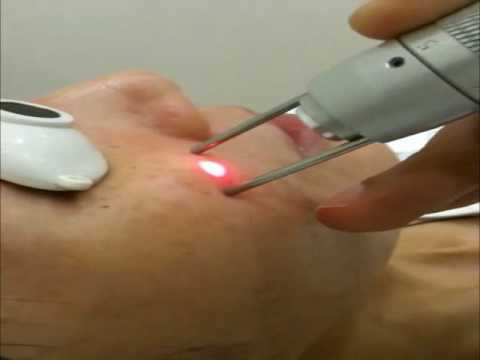 LASER MEDLITE