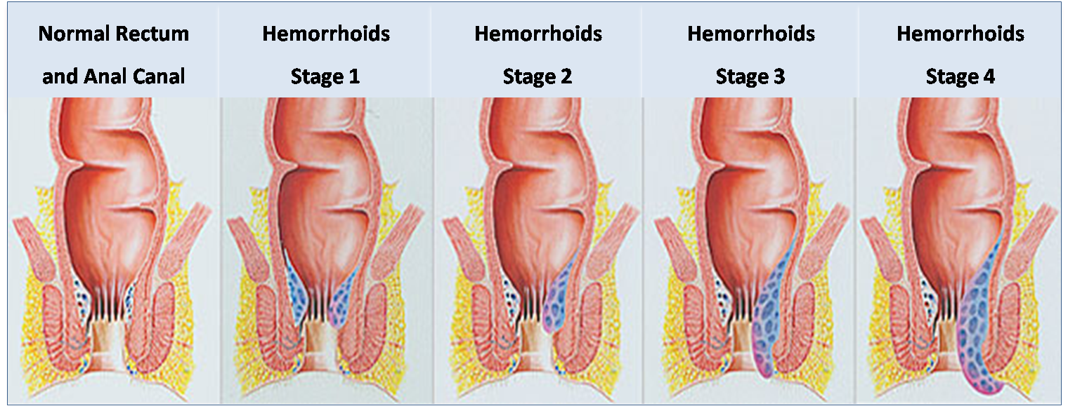 hemorrhoid surgery