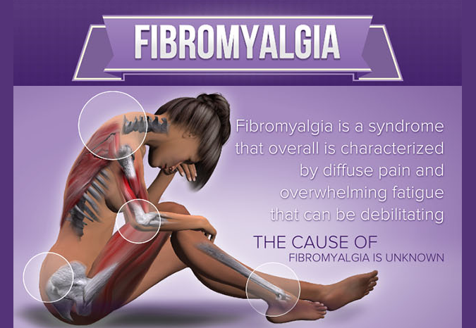 Image: Fibromyalgia