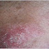 Psoriasis