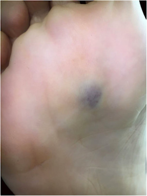Dabska's tumour - Violaceous lesion, with poorly defined limits, on the sole of the right foot.