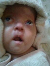 My apert syndrome baby