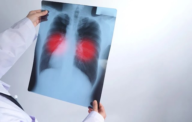 Tuberculose: 15 cidades concentram 86% dos casos no RJ, diz Secretaria Estadual de Saúde
