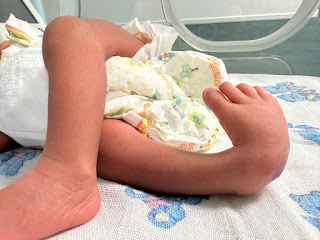 A neonate patient with lower limb deformity at the maternity hospital in Luanda, Angola.