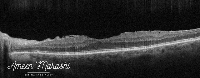 OCT cross-section shows epiretinal membrane