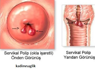 Rahim Ağzı Polip Alınmazsa Ne Olur