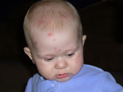 chicken pox baby. of the Chicken Pox so that