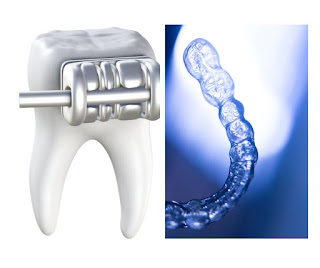 Orthodontic treatment - braces and clear aligners Treatment for Misaligned Bite