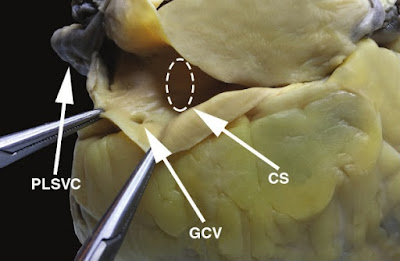 The left superior vena cava drains into the coronary sinus in this heart specimen. CS, coronary sinus; GCV, great cardiac vein; PLSVC, persistent left superior vena cava.