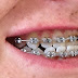Chỉnh răng bị móm bằng niềng răng giá bao nhiêu?