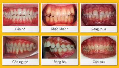 Các bước niềng răng lệch khớp cắn