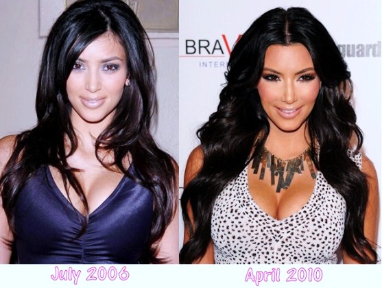 kim kardashian plastic surgery 2011. fergie plastic surgery before
