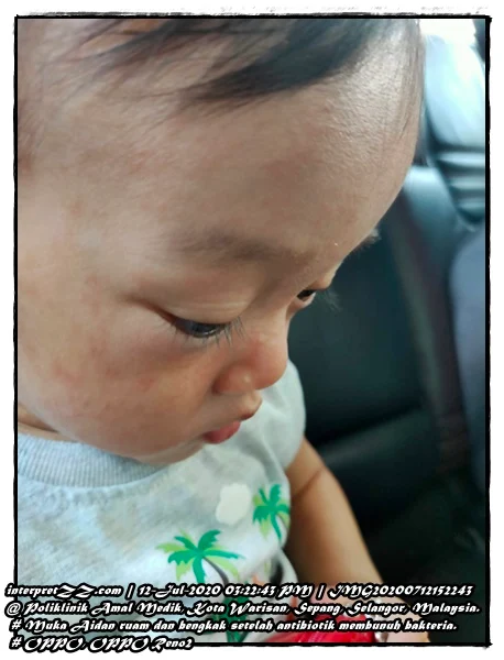 Gambar muka bayi lelaki ada ruam dan kesan bengkak setelah antibiotik membunuh bakteria.