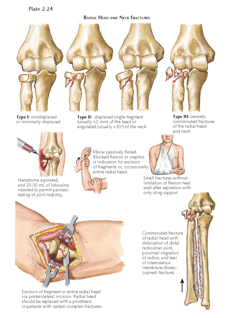 RADIAL HEAD AND NECK FRACTURES