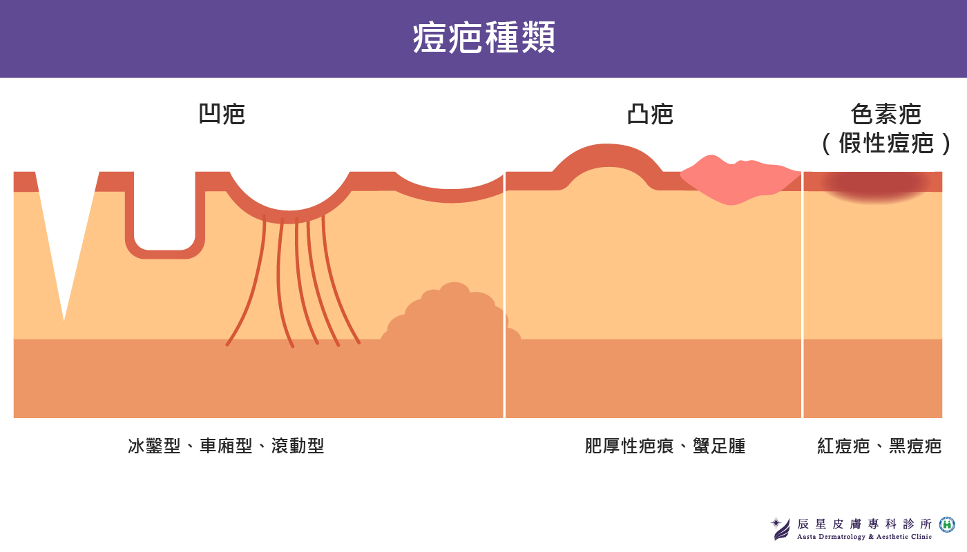 痘疤的三大類型，大致分為色素型疤痕、凸疤及凹疤，皮膚專科醫師會依據最接近患者期待效果，經評估後給予不同的治療方式。