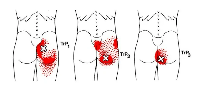 lumbalgia y ciática - gluteo máximo - mc spa