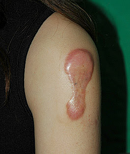 Tattoo Keloid