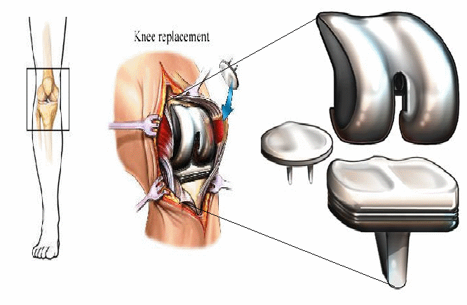 China Artificial joint Industry