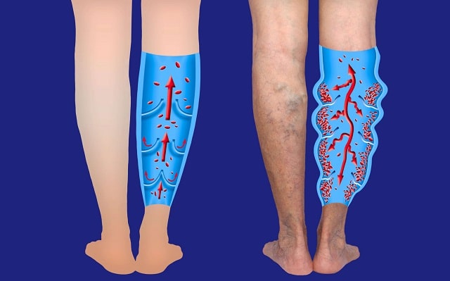 professional treatment large engorged varicose veins leg pain