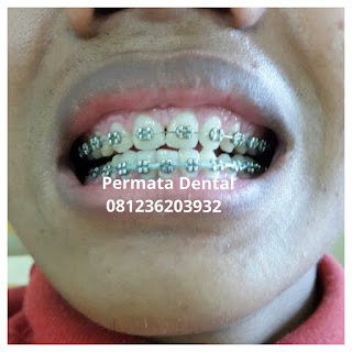 gambar foto behel bracket kawat gigi sebelum dan sesudah perawatan untuk memperbaiki merapikan gigi gingsul gigi miring renggang tonggos berantakan keluar masuk jarang diastema maju mundur tidak rapi tidak beraturan bali denpasar banyuwangi jember tidak rata kocar kacir