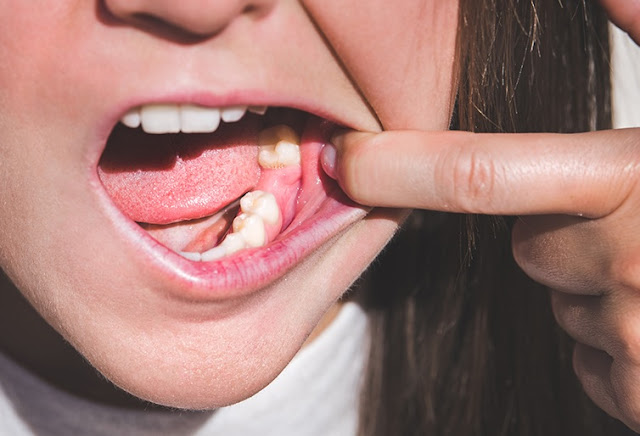 Una ragazza di 27 anni mostra il vuoto della mascella sinistra dove ha perso il dente