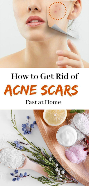 Get Rid of Acne Marks Using Homemade Remedies