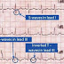 S1Q3T3 Pulmonary Embolism ECG/EKG Classic Pattern