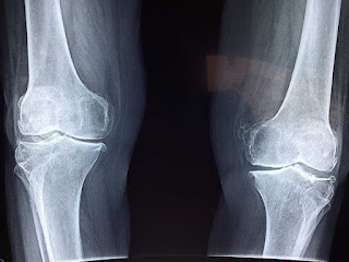 X-ray of bones connecting in the knees