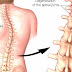 Scoliosis