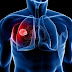 Estimating Mesothelioma Survival Time