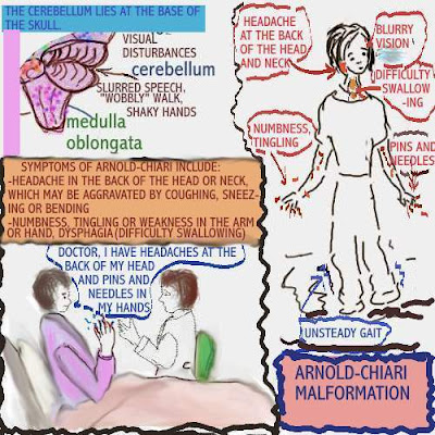 Arnold-Chiari Malformation is considered to be a rare condition.